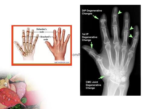 tratamentul osteoartrozei articulațiilor interfalangiene distale ale mâinilor