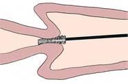 direcție Figura 3. cu 90-180à. Se scoate Recoltarea cu periuța cervicală periuța.