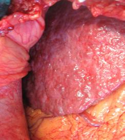 fasciculată a pediculului vascular splenic (7%) Monitorizând modificările anatomopatologice importante (fig 3), ca parametru al gravității afecțiunii hepato-splenice, cu eventuale repercusiuni asupra