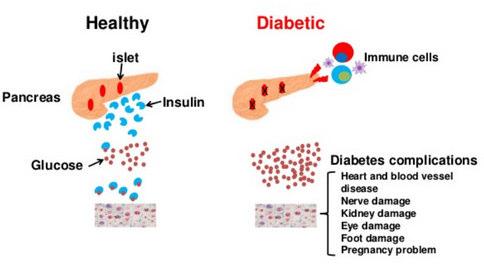 Diabetul zaharat Clasificare clinică Insulinodependent - tip I debut rapid tineri (juvenil) Complicații cronice renale Factori Diabet Tip 1