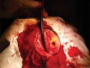 FIGURA 1. Aspect intraoperator fabricarea cadrului cartilaginos FIGURA 2. Aspect intraoperator implantarea cadrului cartilaginos bricat după urechea contralaterală este utilă (Fig. 1).