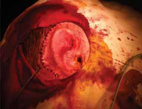 Implantarea cadrului cartilaginos s-a făcut printr-o incizie postero-superioară, la cca 1-2 cm de locul poziţionării finale a helixului.
