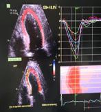 În evoluţie, datorită presiunilor intracardiace şi a presarcinii crescute, observăm apariţia HVS concentrice (SIV 1,3 cm, PPVS 1,25 cm), ectaziei de aortă ascendentă (Ao asc 4,3 cm) şi dilatarea AS