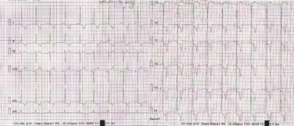 Prezentare de caz O formă obstructivă particulară de cardiomiopatie hipertrofică 1 Institutul de Boli Cardiovasculare Prof. Dr. George I.M.