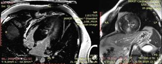 În ceea ce priveşte performanţa sistolică ventriculară stângă se remarcă prezervarea fracţiei de ejecţie (FEvol 70%), însă cu scăderea deformării longitudinale globale, cu un GLS de -13,3% (fig. 6).