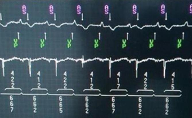 Fig. 4. Interogarea stimulatorului post upgrade cu evidenţierea conducerii VA retrograde Fig. 5. ECG post upgrade de stimulator. Ritm atrial şi ventricular electroantrenat, AV 60/min.