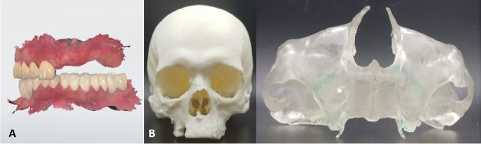 printate 3D Cazuistică Omni Dent s-a efectuat metoda free-hand de instalare a implanturilor, în 5 cazuri protocolul static ghidat utilizând șabloane chirurgicale În toate cazurile clinice s-a recurs