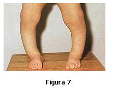 22. Analizaţi figura nr.7 şi alegeţi asocierea corectă între boala prezentată în imagine şi cauza producerii acesteia: A. scorbut avitaminoza A; B.
