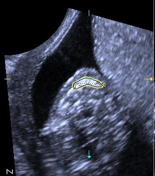Fătul din figura 2, la vârsta gestaţională de 13 săptămâni şi 5 zile, ecografia tridimensională multiplanară cu