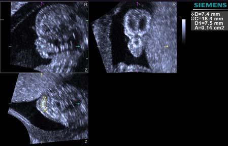 Stânga sus secţiunea sagitală craniană fetală, dreapta sus- secţiune coronală cu triunghiul retronazal descris de
