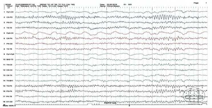Specific patterns following intermittent light stimulation of a patient with
