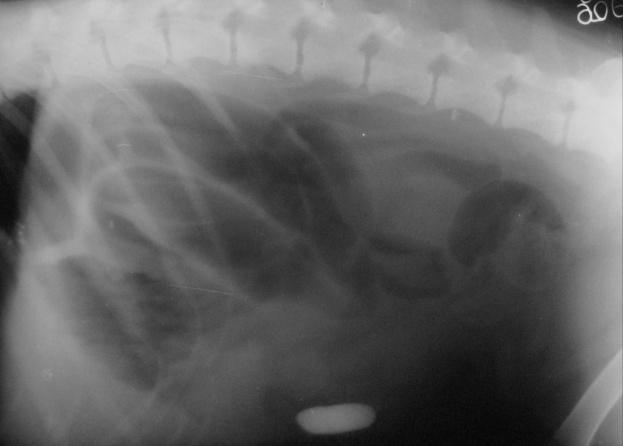 Ileus/obstrucţie mecanică Modificări radiografice radiografie simplă: - dilataţia intestinului se produce proximal de obstrucţie (fig.
