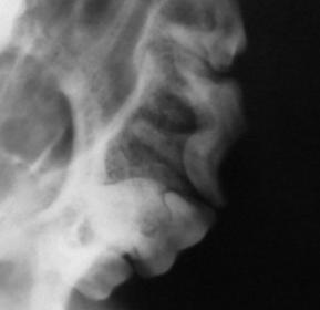 - alte semne radiografice observate în cazul abceselor periapicale sunt: liza sau necroza osoasă adiacentă a apexului, pierderea laminei dura şi resorbţia rădăcinii dintelui. Fig. 22.