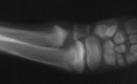 AFECŢIUNI CU ETIOLOGIE NECUNOSCUT Osteodistrofia hipertrofică - leziunile osoase rezultate sunt dispuse simetric - bilateral şi implică metafizele oaselor lungi (radius, ulna tibia); Forma acută: -