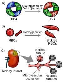 Hemoglobina Anemia falciformă