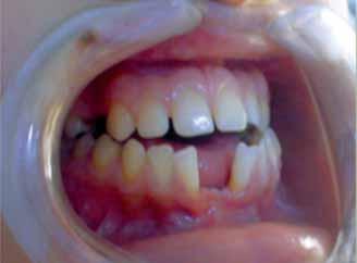 urmare a extracţiilor lui 14 şi 36; recesiuni parodontale la 31 şi 41; diastemă şi treme interincisive la arcada superioară; diastemă de 12 mm la arcada mandibulară (pentru care