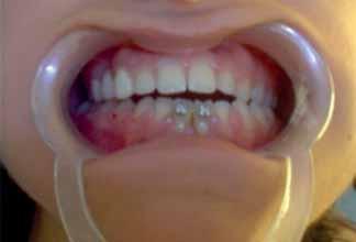 vecini (31 şi 41); zone de radiopacitate la nivelul corpului mandibular în zona crestei edentate lateral stânga şi în zona apexurilor premolarilor de partea dreaptă.
