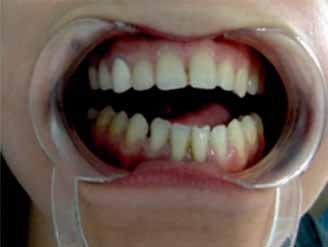 4 se observă rezultatele terapiei ortodontice întrerupte la cererea pacientei: închiderea diastemei mandibulare şi a tremelor maxilare, corectarea inocluziei sagitale şi a ocluziei inverse frontale,