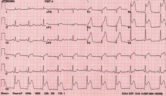Infarct miocardic acut Semnul EKG patognomonic: