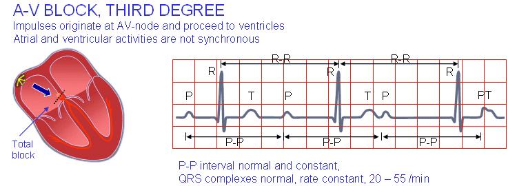 BAV grad III (complet) Unde P fara legatura cu QRS (unde P neconduse la ventricul) Rim vetricular