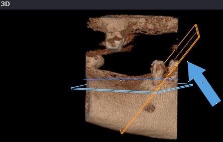Dental programul unde lucram uzual Verification se verifica simularea unui implant Panorama fereastra panorama in toate cele patru moduri (MPR, MIP,