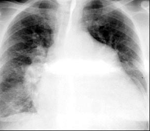 Radiografia marirea cavitatilor stangi