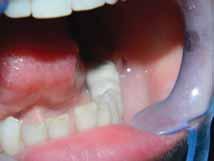 La mandibulă s-au efectuat tratamente odontale şi parodontale ale dinţilor restanţi şi s-au introdus FIGURA 2.