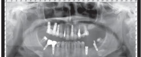 Ortopantomograma iniţială ce evidenţiază raportul dinţilor cu structurile anatomice învecinate: sinusurile maxilare şi traiectul canalului mandibular.