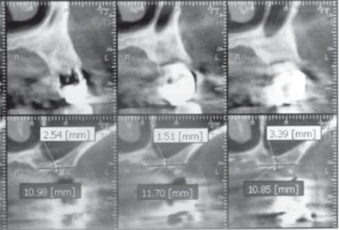 206 FIGURA 7. Ortopantomografie realizată după inserarea implanturilor în cadranul II, pe poziţiile 2.4, 2.5, 2.7, 2.8, cât şi integrarea acestora şi protezarea definitivă Figura 6. A.