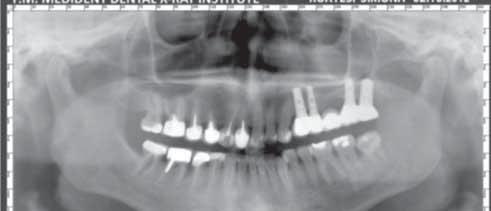 Imagine a întregii arcade maxilare, cu secţiuni step de 2 mm la nivelul zonei premolare, unde se evidenţiază secvenţial parametrii osoşi, poziţionarea şi implantarea dinţilor şi vecinătatea cu
