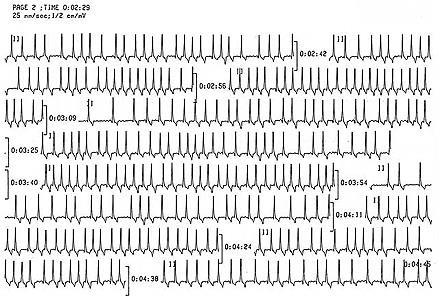 Holter EKG Interpretarea traseului EKG este facuta de catre