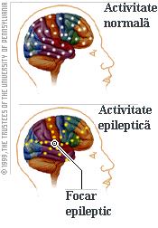 X. Acordarea primului ajutor la pacientul cu epilepsie Epilepsia este o tulburare neurologica comuna care se datoreaza unor factori care interfereaza cu impulsurile electrice la nivelul creierului.