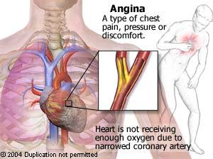 Care sunt semnele infarctului miocardic acut? - durere toracică anterioară intensă, cu caracter de presiune, arsură, greutate, strângere sau sfredelire.