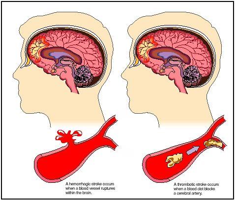 XIV. Acordarea primului ajutor la pacientul cu accident vascular cerebral (AVC) Un accident vascular cerebral apare atunci cand un vas de sange (o artera) care furnizeaza sange la nivelul unei zone a