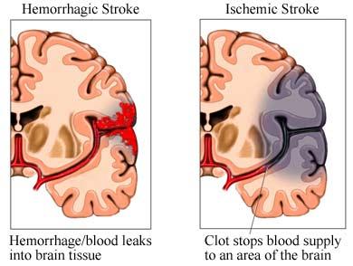 Mecanism fiziopatologic In cazul unui accident vascular cerebral ischemic, se reduce aportul de sange bogat in oxigen in zona respectiva a creierului.