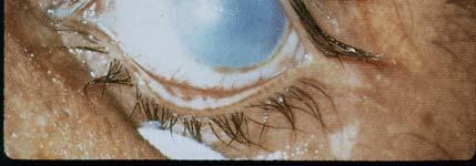 globului ocular Intirziata - opacifierea corneana -