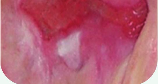 Răni roz Pansamente recomandate pentru rănile roz (în funcție de nivelul de exudat şi adâncimea rănii) Medisorb H pansament cu hidrocoloid răni cu exudat moderat şi scăzut; răni superficiale Medisorb