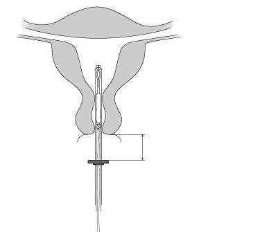 3. Menţineţi cursorul în poziţia menţionată, poziţionaţi marginea superioară a manşonului astfel încât să corespundă cu adâncimea uterului şi a valorii histerometriei (Figura 3).