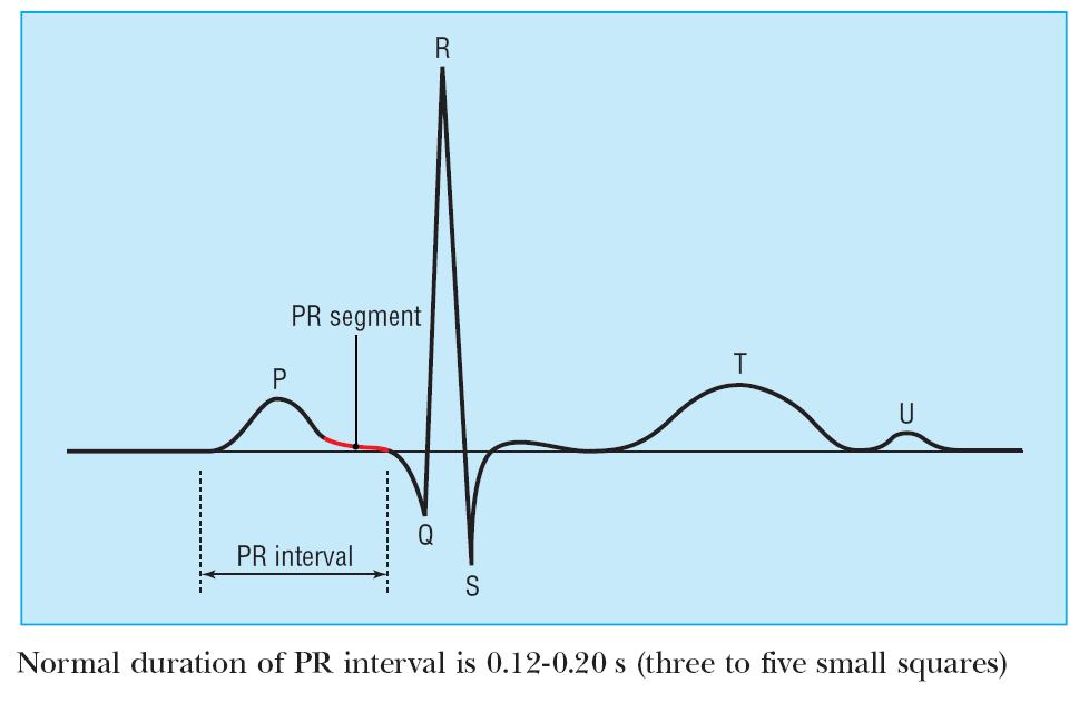 U wave U wave related to afterdepolarizations which follow repolarization U waves are small, round, symmetrical and