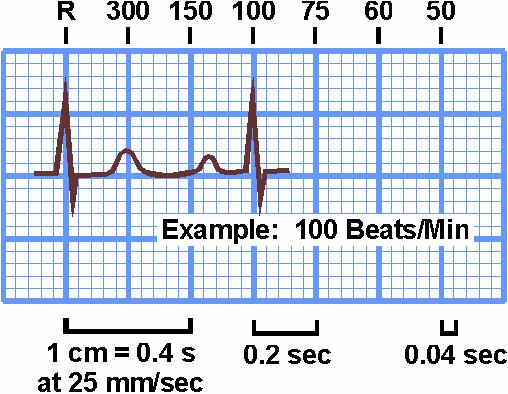 Determinarea rapidă a frecvenţei cardiace REGULA LUI 300 se caută pe ECG o undă R suprapusă peste o linie groasă