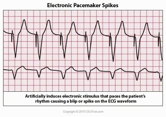 Aspecte particulare EKG stimulator cardiac Stimul electric artificial care