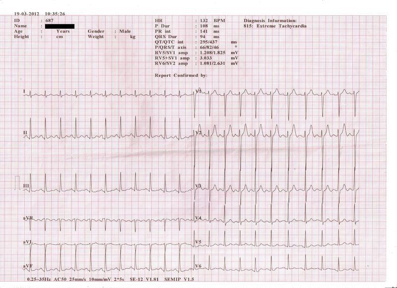 Tahicardia sinusala Accelerarea ritmului cardiac normal (ritm sinusal) cu atingerea unei
