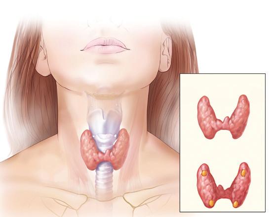 Glanda tiroidă este învelită într-o capsulă și este formată din foliculi (vezicule) delimitați de celule secretoare.