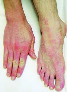 Case 20 yo male acute-onset pain & swelling of hands, feet, oropharynx increasing pruritus of hands & feet petechial eruption over edematous, tender, distal extremities gloves and