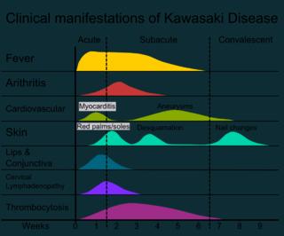 glove-and-sock syndrome Kawasaki disease: autoimmune, medium & small sized blood