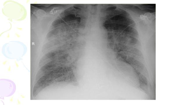 Particularitățile evaluării copiilor cu COVID-19 Cea mai frecventă manifestare a SARI este o pneumonie virală bilaterală complicată de ARDS sau edem pulmonar.