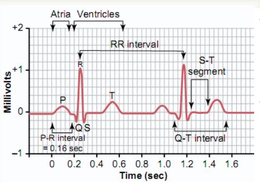 Caracteristici ale EKG normale Electrocardiograma normala este formata dintr-un numar de unde, pozitive si negative, conectate prin segmente de linii