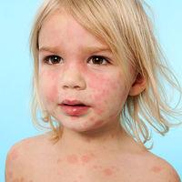 Urticaria I. ACUTĂ La copii/adulți 90% etiologie infecțioasă (virală, bact, etc.