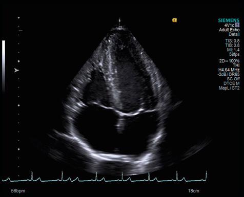inel aortic, HVS concentrică (SIV 15 mm, PPVS 14,5 mm), dilatare biatrială (AS 40/47/53 mm, AD 46/54 mm) (Figura 2), funcție sistolică normală VS, FE 55%, iar radiografia toracică nu a decelat