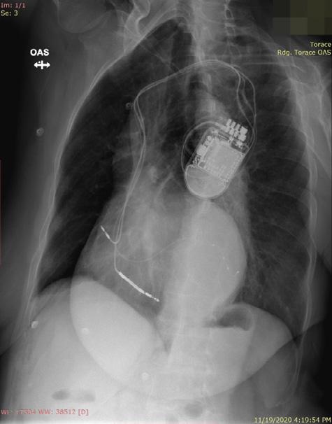 Fig. 8. Ecocardiografia de control după implantarea defibrilatorului tricameral Fig. 6.